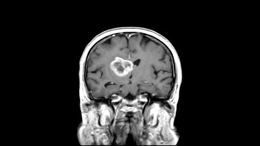 Unlocking the Potential of Herbal Medicine for Glioblastoma Treatment: A Promising Breakthrough