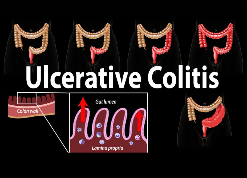 Herbal Approaches for Managing Ulcerative Colitis: Exploring Botanical Remedies.