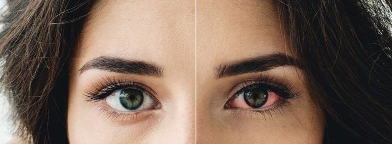 Boost Your Eye Health Naturally with Herbal Remedies!