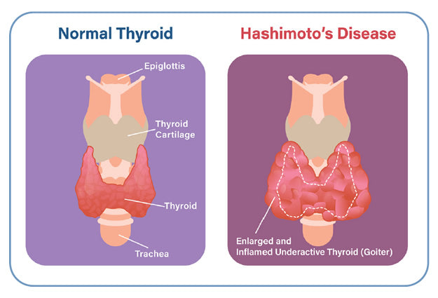 Hashimoto's: 10 Vital Steps to Balance Thyroid Hormones – Stem n Rootz