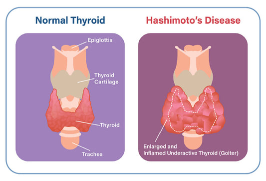 Hashimoto's: 10 Vital Steps to Balance Thyroid Hormones