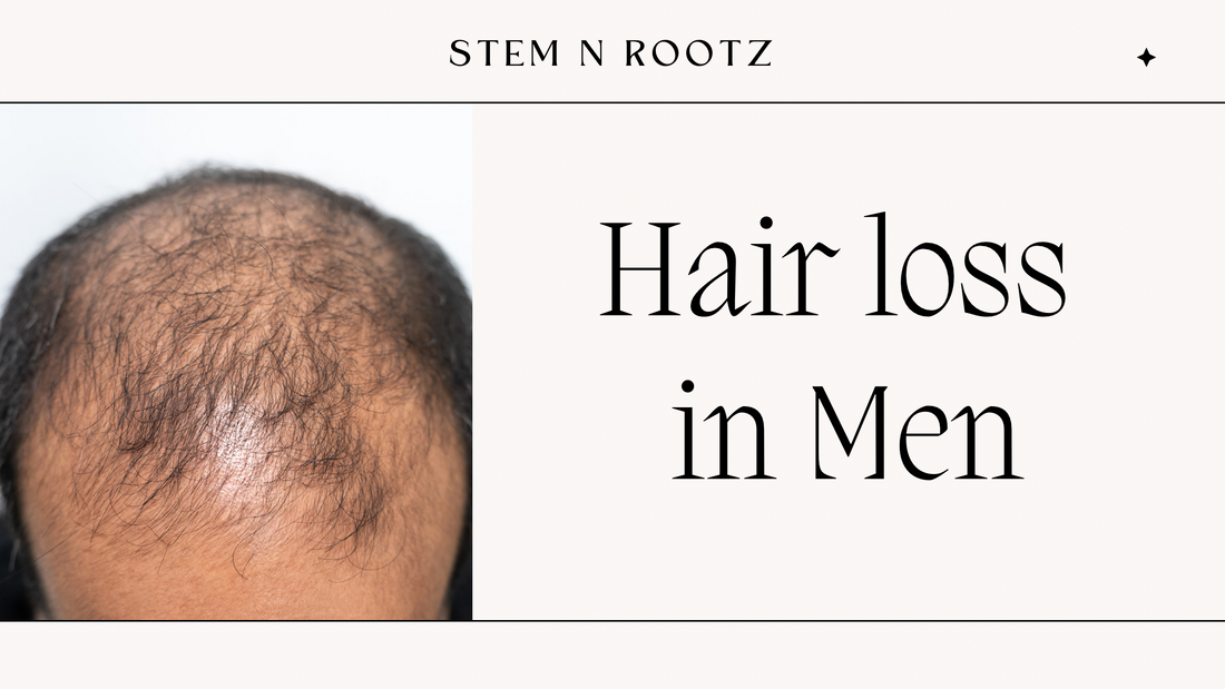 Hair Loss in Men